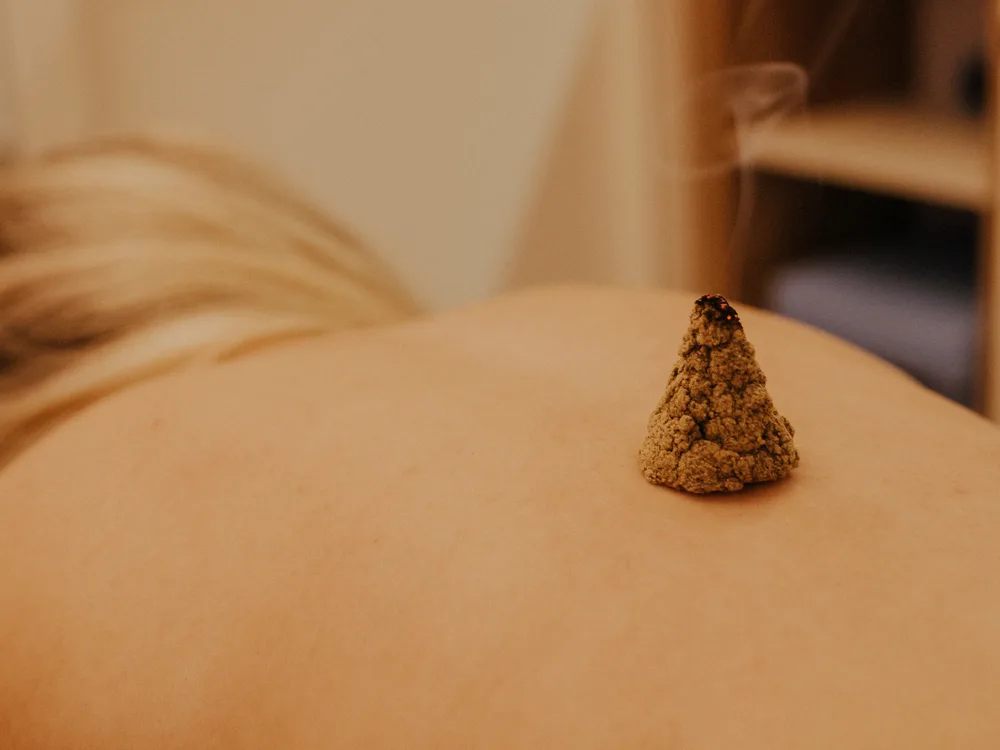 Moxabustão: cone de moxa com calor terapêutico sobre ponto de acupuntura
